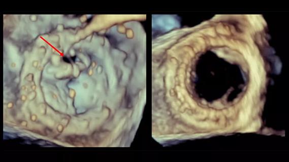 3D transesophageal echocardiographic images