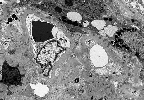 Electron microscopy of glomerulus from patient with lupus