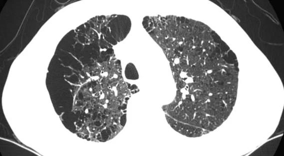 Lung-CT-690&#215;380