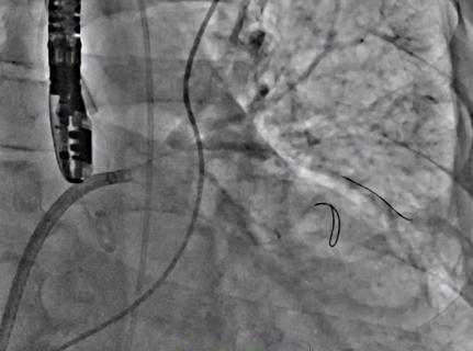 occluded pulmonary vein on angiography