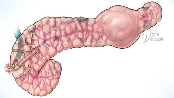 medical drawing of a pancreas with pancreatitis