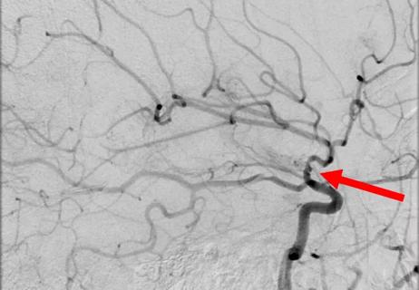 18-NEU-736-Friedman-Pediatric-Stroke-650&#215;450