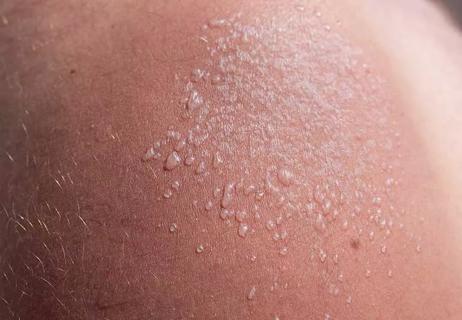 6 Best Natural Ingredients for Alleviating Sunburn Pain - Tri-City Medical  Center