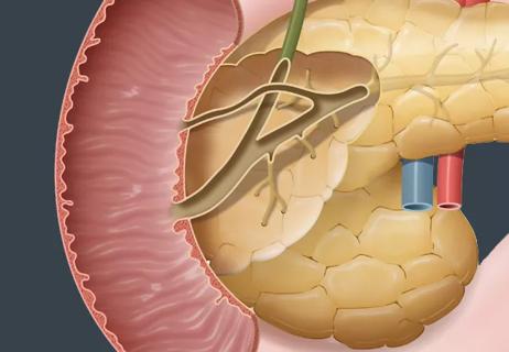 21-DDI-2103514-CQD-Benign-Sporadic-Adenomas-DDW-2