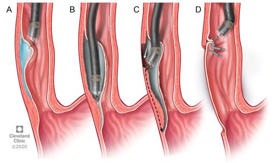 POEM procedure