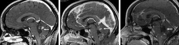 590x-Inset-Interop-Brain-Tumor