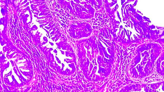 Squamous cell carcinoma