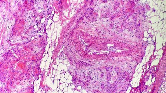 Squamous cell carcinoma