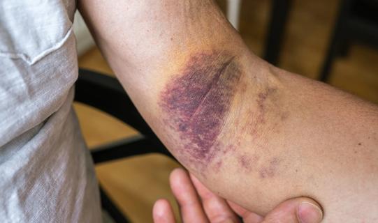 Deep purple bruise on the inside of elbow