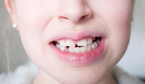 Close up of child's chipped teeth