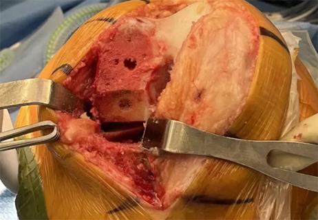 Knee surgery