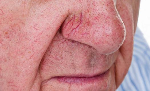 spider veins on man's nose and face