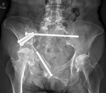 X-ray of pelvic ring fixation
