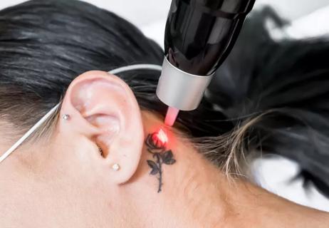 Woman going through tattoo removal on neck