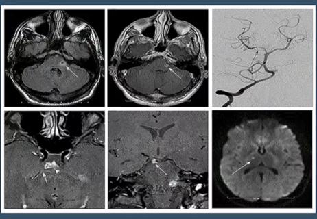 A series of brain MRI images used to help diagnose CNS vasculitis