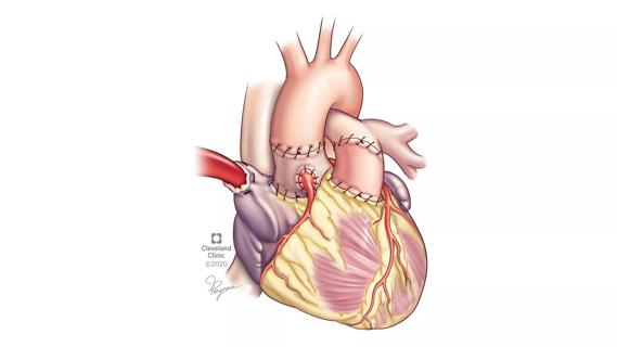 Illustration of heart after Ross procedure
