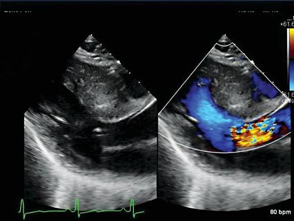 Hypertrophic Cardiomyopathy