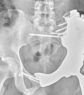 X-ray of pelvis implant