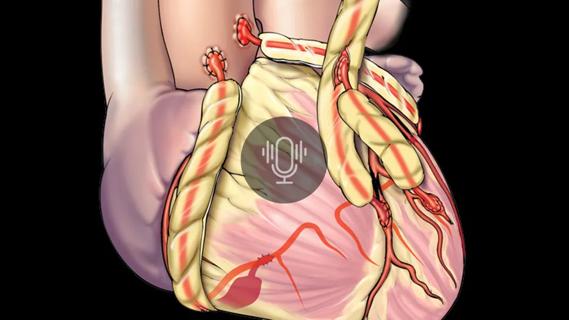 illustration of heart with bypass grafts and a podcast overlay
