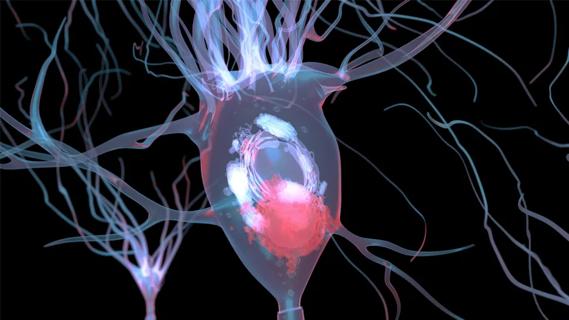 Lewy body in neuron affected by Parkinson’s disease