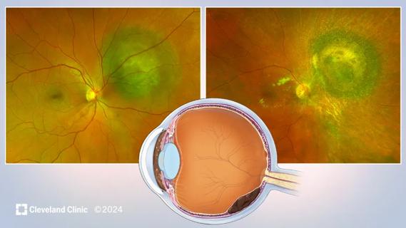 20-EYE-1989584-CQD-Case-study-melanoma-Iris-Hero