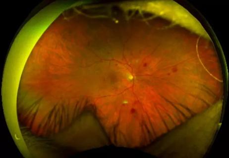 Diabetic retinopathy