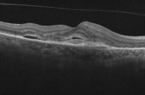Optical coherence tomography image showing macular fluid