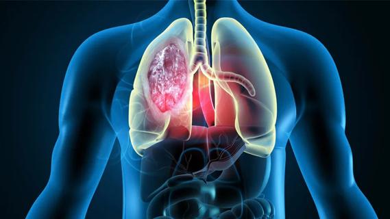 Lung cancer illustration