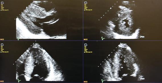 Echocardiogram demonstrating left ventricular hypertrophy and typical bright speckled appearance