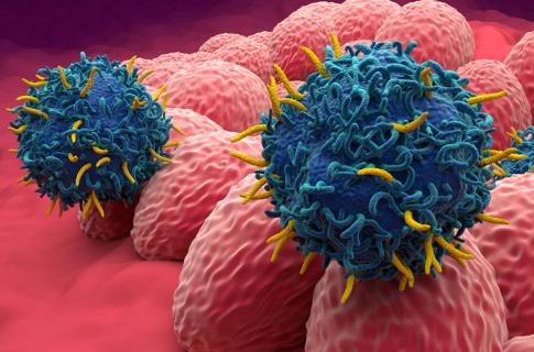 Endometrial cancer