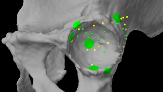 Assessment of hip socket by robotic system