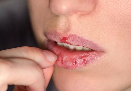 Woman picking at the skin on her lips