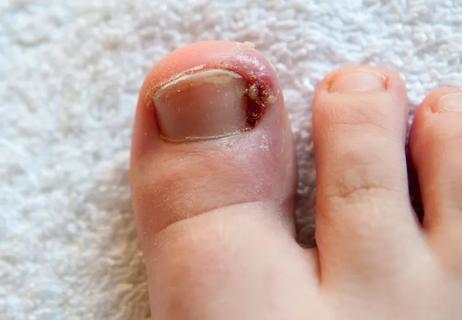 Ingrown and infected toenail