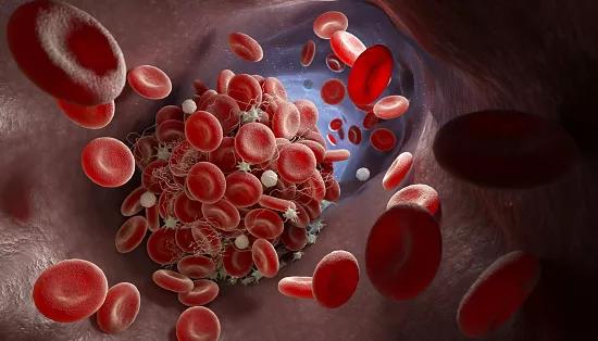 Depiction of a blood clot forming inside a blood vessel. 3D illustration