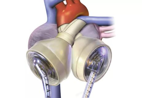 Total Artificial Heart as Bridge to Transplant in Biventricular Heart Failure