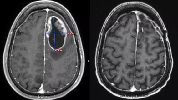 brain cancer immunotherapy vaccine Cleveland Clinic