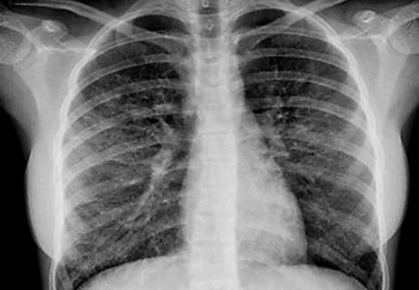 Chest x-ray adolescent vaping injury