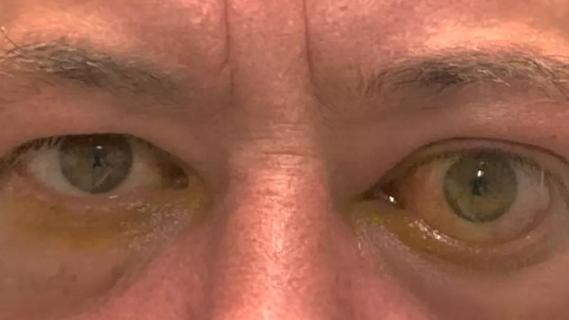 Patient with thyroid eye disease