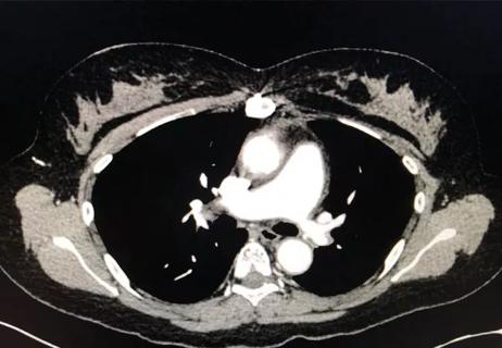 pulmonary artery stenosis