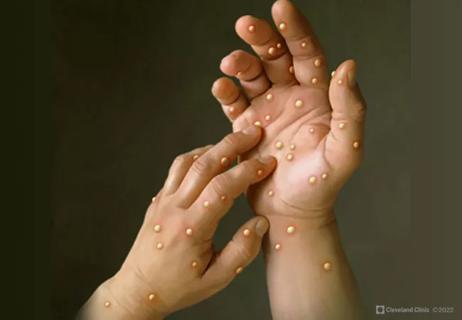 monkeypox rash