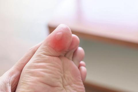 Blister on bottom of big toe