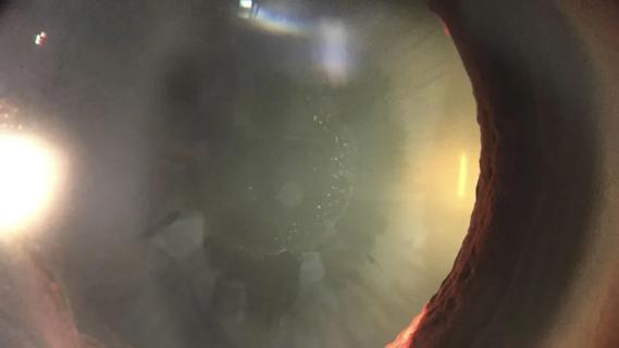 Pseudoexfoliation glaucoma