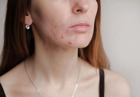 Closeup of jawline with inflamed, red acne