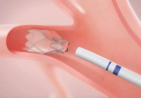 Lung-Valves-Final-Med-sm-v2