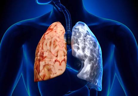 lung transplant