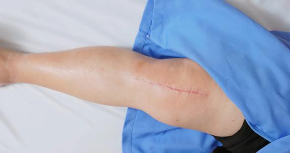 Knee with surgery scar