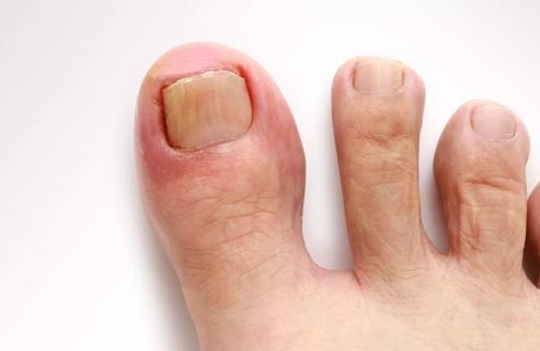 Ingrown toenail on big toe