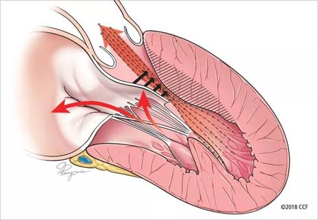 Obstructive hypertrophic cardiomyopathy