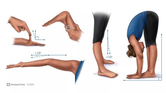 medical illustration of Ehlers-Danlos hypermobility