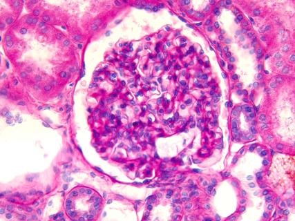 Pathology slide of IgA